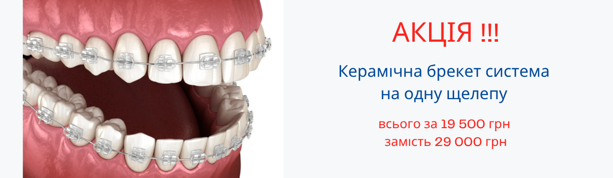 Акция! Керамическая брекет система (одна челюсть) 19 500 грн вместо 29000 грн. Ваша экономия 9500 грн.